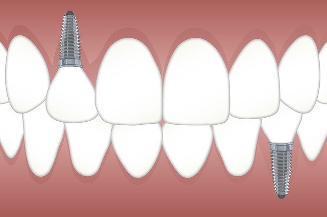 implant dentaire caen